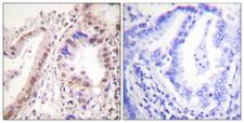 ER Alpha / Estrogen Receptor Antibody - Immunohistochemistry analysis of paraffin-embedded human lung carcinoma tissue, using Estrogen Receptor-alpha Antibody. The picture on the right is blocked with the synthesized peptide.