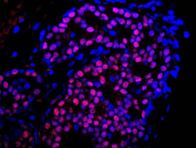 ER Alpha / Estrogen Receptor Antibody - Detection of Human Estrogen Receptor alpha by Immunofluorescence. Sample: FFPE section of human breast adenocarcinoma. Antibody: Affinity purified rabbit anti-ER alpha used at a dilution of 1:100. Detection: Red-fluorescent goat anti-rabbit IgG highly cross-adsorbed Antibody used at a dilution of 1:100. Epitope Retrieval Buffer-High pH (IHC-101J) was substituted for Epitope Retrieval Buffer-Reduced pH.