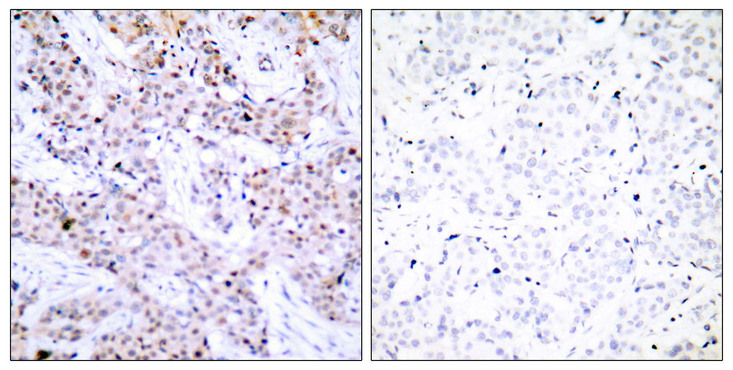 ER Alpha / Estrogen Receptor Antibody - Immunohistochemistry analysis of paraffin-embedded human breast carcinoma tissue, using Estrogen Receptor-alpha Antibody. The picture on the right is blocked with the synthesized peptide.