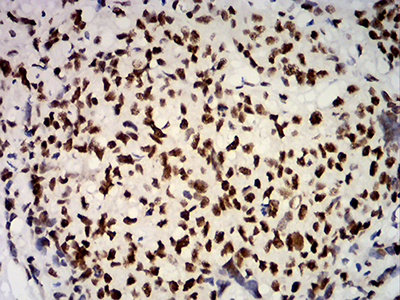 ER Alpha / Estrogen Receptor Antibody - Immunohistochemical analysis of paraffin-embedded breast cancer tissues using ESR1 mouse mAb with DAB staining.
