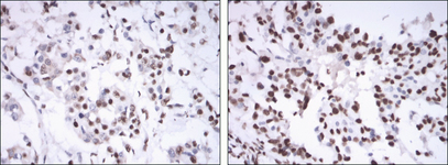 ER Alpha / Estrogen Receptor Antibody - IHC of paraffin-embedded mammary cancer tissues using ESR1 mouse monoclonal antibody with DAB staining.