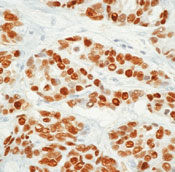 ER Alpha / Estrogen Receptor Antibody - Formalin-fixed, paraffin-embedded human breast carcinoma stained with peroxidase-conjugate and DAB chromogen. Note intense nuclear staining of tumor cells.