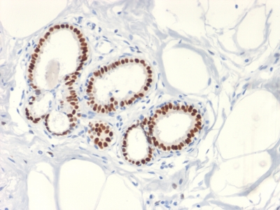 ER Alpha / Estrogen Receptor Antibody - Formalin fixed paraffin embedded human Breast Carcinoma stained with Estrogen Receptor, alpha Rabbit Recombinant Monoclonal Antibody (ESR1/2299R).