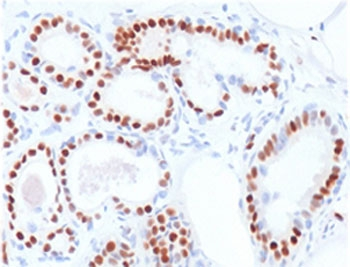 ER Alpha / Estrogen Receptor Antibody - IHC testing of human breast carcinoma stained with ER alpha antibody (clone NR3Ga-2). Staining of formalin-fixed tissues requires boiling tissue sections in 10mM citrate buffer, pH 6.0, for 10-20 min followed by cooling at RT for 20 minutes.