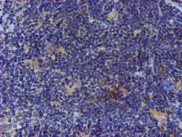 ER Alpha / Estrogen Receptor Antibody - IHC of paraffin-embedded Human lymphoma tissue using anti-ESR1 mouse monoclonal antibody.