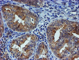 ER Alpha / Estrogen Receptor Antibody - IHC of paraffin-embedded Adenocarcinoma of Human endometrium tissue using anti-ESR1 mouse monoclonal antibody.