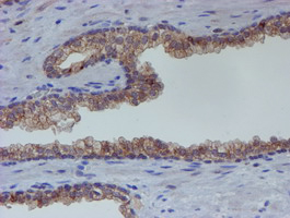 ER Alpha / Estrogen Receptor Antibody - IHC of paraffin-embedded Carcinoma of Human prostate tissue using anti-ESR1 mouse monoclonal antibody.