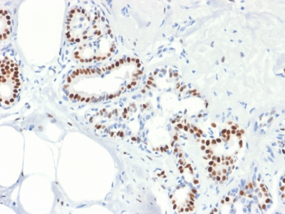 ER Alpha / Estrogen Receptor Antibody - Formalin-fixed, paraffin-embedded human Breast Carcinoma stained with Estrogen Receptor, alpha Mouse Recombinant Monoclonal Antibody (rESR1/1935).