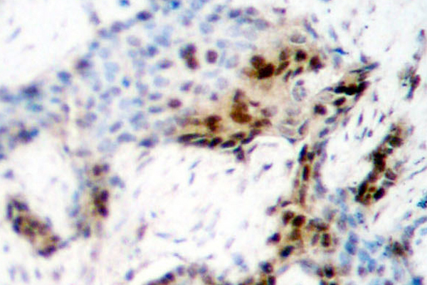 ER Alpha / Estrogen Receptor Antibody - IHC of Estrogen Receptor- (H112) pAb in paraffin-embedded human breast carcinoma tissue.