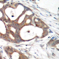ER Alpha / Estrogen Receptor Antibody - Immunohistochemical analysis of Estrogen Receptor alpha staining in human breast cancer formalin fixed paraffin embedded tissue section. The section was pre-treated using heat mediated antigen retrieval with sodium citrate buffer (pH 6.0). The section was then incubated with the antibody at room temperature and detected using an HRP polymer system. DAB was used as the chromogen. The section was then counterstained with hematoxylin and mounted with DPX.