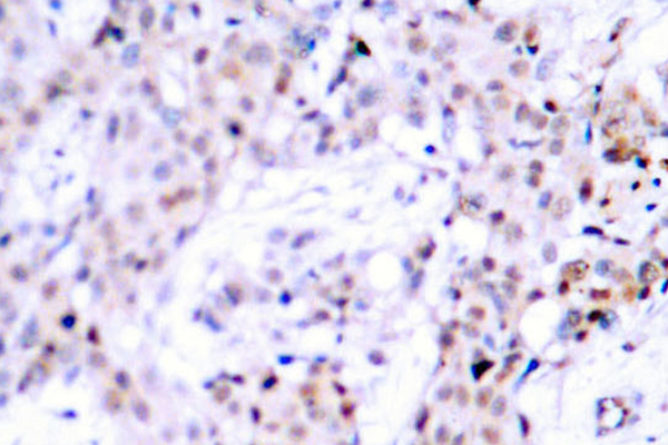 ER Alpha / Estrogen Receptor Antibody - IHC of Estrogen Receptor- (L100) pAb in paraffin-embedded human breast carcinoma tissue.