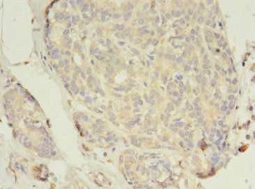 ER Alpha / Estrogen Receptor Antibody - Immunohistochemistry of paraffin-embedded human breast cancer using ESR1 Antibody at dilution of 1:100