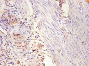 ER Alpha / Estrogen Receptor Antibody - Immunohistochemistry of paraffin-embedded human breast cancer using antibody at 1:100 dilution..  This image was taken for the unconjugated form of this product. Other forms have not been tested.