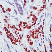 ER Alpha / Estrogen Receptor Antibody - Formalin-fixed, paraffin-embedded human breast carcinoma stained with peroxidase-conjugate and AEC chromogen. Note nuclear staining of tumor cells.  This image was taken for the unmodified form of this product. Other forms have not been tested.