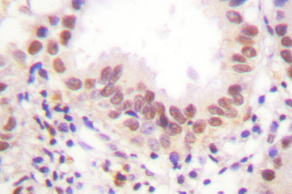 ER Alpha / Estrogen Receptor Antibody - IHC of ER- (K531) pAb in paraffin-embedded human lung carcinoma tissue.