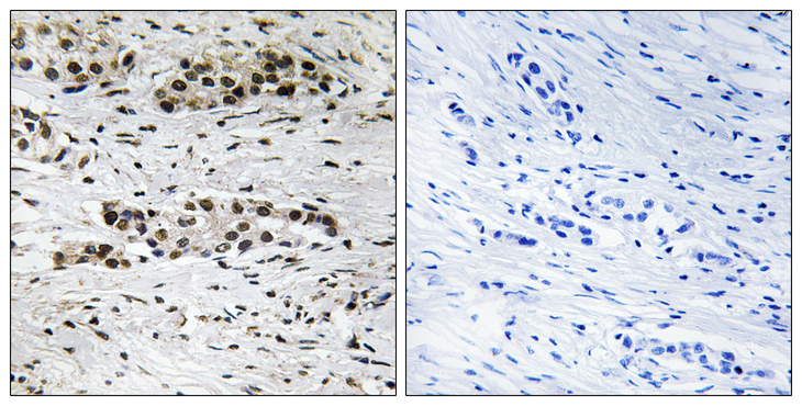 ER Alpha / Estrogen Receptor Antibody - Immunohistochemistry analysis of paraffin-embedded human breast carcinoma, using Estrogen Receptor-alpha (Phospho-Ser102) Antibody. The picture on the right is blocked with the phospho peptide.