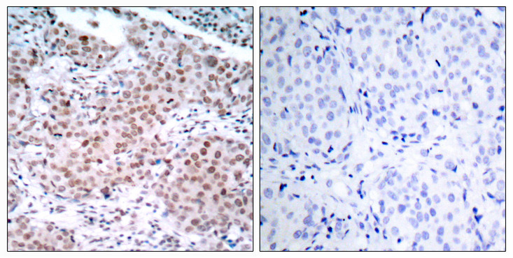 ER Alpha / Estrogen Receptor Antibody - Immunohistochemistry analysis of paraffin-embedded human breast carcinoma, using Estrogen Receptor-alpha (Phospho-Ser104) Antibody. The picture on the right is blocked with the phospho peptide.