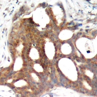 ER Alpha / Estrogen Receptor Antibody - Immunohistochemical analysis of Estrogen Receptor alpha (pS104) staining in human breast cancer formalin fixed paraffin embedded tissue section. The section was pre-treated using heat mediated antigen retrieval with sodium citrate buffer (pH 6.0). The section was then incubated with the antibody at room temperature and detected using an HRP polymer system. DAB was used as the chromogen. The section was then counterstained with hematoxylin and mounted with DPX.