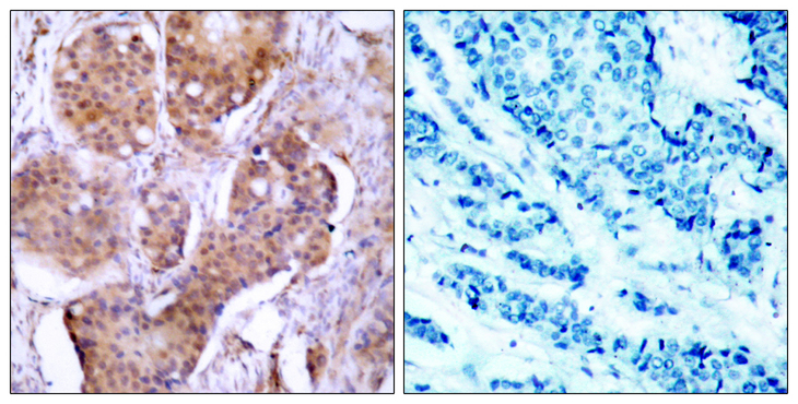 ER Alpha / Estrogen Receptor Antibody - Immunohistochemistry analysis of paraffin-embedded human breast carcinoma, using Estrogen Receptor-alpha (Phospho-Ser106) Antibody. The picture on the right is blocked with the phospho peptide.