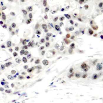 ER Alpha / Estrogen Receptor Antibody - Immunohistochemical analysis of paraffin-embedded human breast carcinoma tissue.