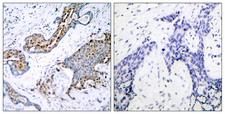 ER Alpha / Estrogen Receptor Antibody - Immunohistochemistry analysis of paraffin-embedded human breast carcinoma, using Estrogen Receptor-alpha (Phospho-Ser118) Antibody. The picture on the right is blocked with the phospho peptide.