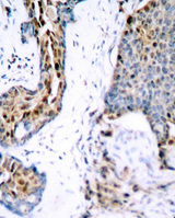 ER Alpha / Estrogen Receptor Antibody - Immunohistochemical analysis of paraffin-embedded human breast carcinoma tissue.