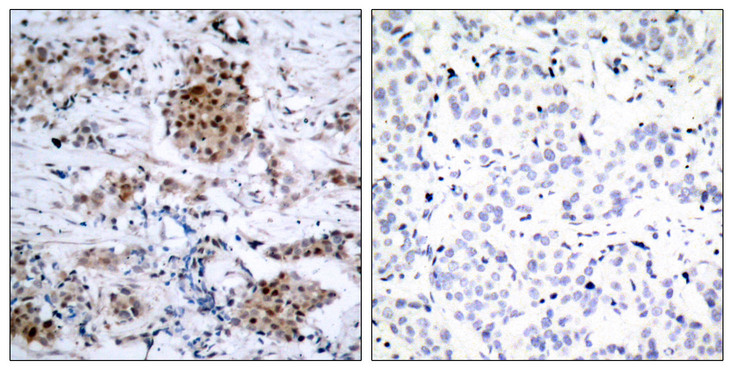 ER Alpha / Estrogen Receptor Antibody - Immunohistochemistry analysis of paraffin-embedded human breast carcinoma, using Estrogen Receptor-alpha (Phospho-Ser167) Antibody. The picture on the right is blocked with the phospho peptide.
