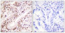 ER Alpha / Estrogen Receptor Antibody - Immunohistochemistry analysis of paraffin-embedded human lung carcinoma, using Estrogen Receptor-alpha (Phospho-Tyr537) Antibody. The picture on the right is blocked with the phospho peptide.