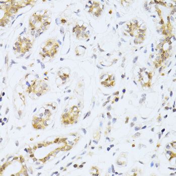 ER81 / ETV1 Antibody - Immunohistochemistry of paraffin-embedded human breast cancer using ETV1 antibody at dilution of 1:100 (40x lens).