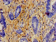 ERAL1 Antibody - Immunohistochemistry of paraffin-embedded human colon cancer using ERAL1 Antibody at dilution of 1:100