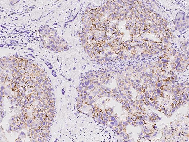 ERBB2 / HER2 Antibody - Immunochemical staining of human ERBB2 in human breast carcinoma with rabbit monoclonal antibody at 1:200 dilution, formalin-fixed paraffin embedded sections.