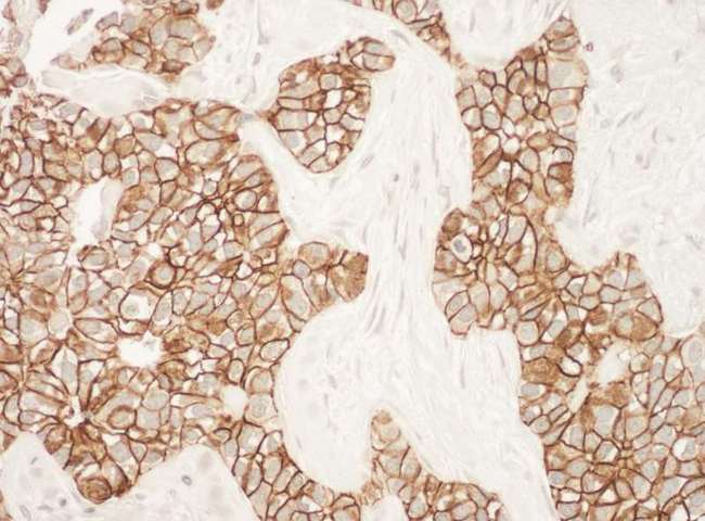 ERBB2 / HER2 Antibody - Detection of Human ErbB2 by Immunohistochemistry. Sample: FFPE section of human breast carcinoma. Antibody: Affinity purified rabbit anti-ErbB2 used at a dilution of 1:200 (1 Detection: DAB.