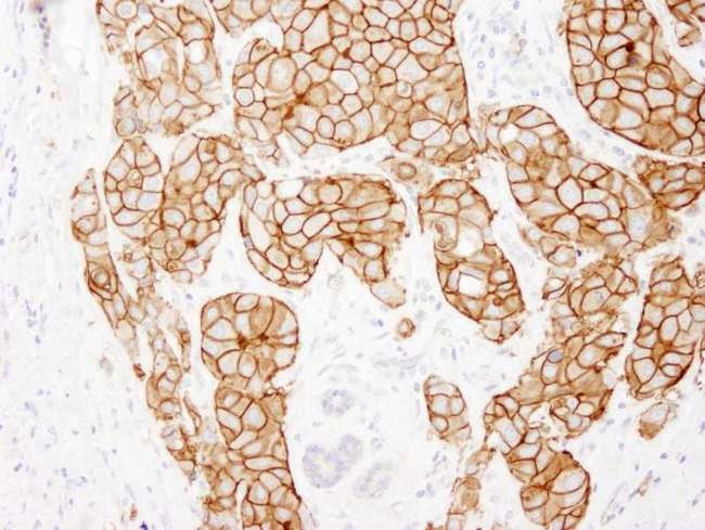 ERBB2 / HER2 Antibody - Detection of Human ErbB2 by Immunohistochemistry. Sample: FFPE section of human breast adenocarcinoma. Antibody: Affinity purified rabbit anti-ErbB2 used at a dilution of 1:250.
