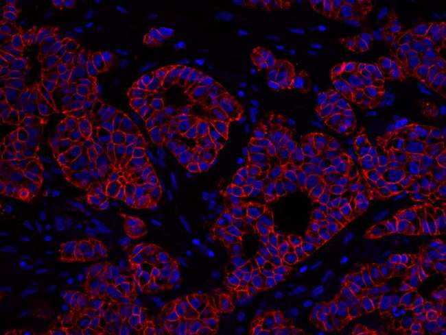 ERBB2 / HER2 Antibody - Detection of Human ErbB2 by Immunofluorescence. Sample: FFPE section of human breast carcinoma. Antibody: Affinity purified rabbit anti-ErbB2 used at a dilution of 1:100. Detection: Red-fluorescent goat anti-rabbit IgG highly cross-adsorbed Antibody.