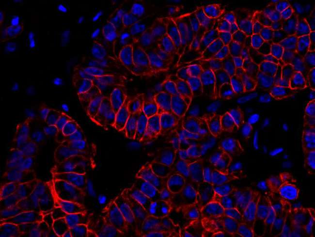 ERBB2 / HER2 Antibody - Detection of Human ErbB2 by Immunofluorescence. Sample: FFPE section of human breast carcinoma. Antibody: Affinity purified rabbit anti-ErbB2 used at a dilution of 1:100. Detection: Red-fluorescent goat anti-rabbit IgG highly cross adsorbed Antibody.