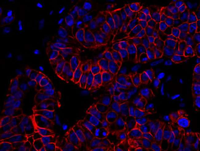ERBB2 / HER2 Antibody - Detection of human ErbB2 by immunohistochemistry. Sample: FFPE section of human breast carcinoma. Antibody: Affinity purified rabbit anti-ErbB2 used at a dilution of 1:100. Detection: Red-fluorescent goat anti-rabbit IgG highly cross-adsorbed antibody.