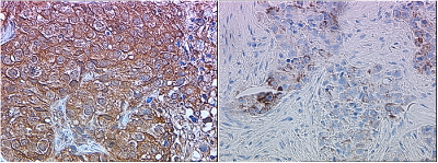 ERBB2 / HER2 Antibody - ERBB2 antibody (4 ug/ml) staining of paraffin embedded Human breast cancer (Her+ left, triple negative right). Steamed antigen retrieval with citrate buffer pH 6, HRP-staining.