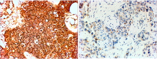 ERBB2 / HER2 Antibody - Goat Anti-ERBB2 / HER2 (aa182-194) Antibody (4µg/ml) staining of paraffin embedded Human breast cancer (Her+ left, triple negative right). Steamed antigen retrieval with citrate buffer pH 6, HRP-staining.