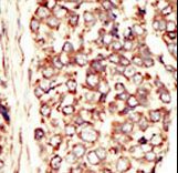 ERBB2 / HER2 Antibody - Formalin-fixed and paraffin-embedded human cancer tissue reacted with the primary antibody, which was peroxidase-conjugated to the secondary antibody, followed by AEC staining. This data demonstrates the use of this antibody for immunohistochemistry; clinical relevance has not been evaluated. BC = breast carcinoma; HC = hepatocarcinoma.