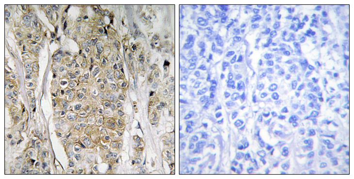 ERBB2 / HER2 Antibody - Immunohistochemistry analysis of paraffin-embedded human breast carcinoma tissue, using HER2 Antibody. The picture on the right is blocked with the synthesized peptide.