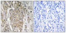 ERBB2 / HER2 Antibody - Immunohistochemistry analysis of paraffin-embedded human breast carcinoma tissue, using HER2 Antibody. The picture on the right is blocked with the synthesized peptide.