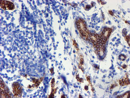 ERBB2 / HER2 Antibody - IHC of paraffin-embedded Adenocarcinoma of Human breast tissue using anti-ERBB2 mouse monoclonal antibody. (Heat-induced epitope retrieval by 10mM citric buffer, pH6.0, 100C for 10min).
