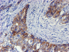 ERBB2 / HER2 Antibody - IHC of paraffin-embedded Carcinoma of Human pancreas tissue using anti-ERBB2 mouse monoclonal antibody. (Heat-induced epitope retrieval by 10mM citric buffer, pH6.0, 100C for 10min).