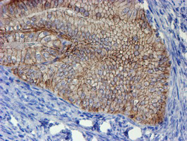 ERBB2 / HER2 Antibody - IHC of paraffin-embedded Adenocarcinoma of Human endometrium tissue using anti-ERBB2 mouse monoclonal antibody. (Heat-induced epitope retrieval by 10mM citric buffer, pH6.0, 100C for 10min).