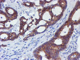 ERBB2 / HER2 Antibody - IHC of paraffin-embedded Adenocarcinoma of Human colon tissue using anti-ERBB2 mouse monoclonal antibody. (Heat-induced epitope retrieval by 10mM citric buffer, pH6.0, 100C for 10min).