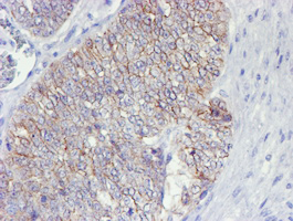 ERBB2 / HER2 Antibody - IHC of paraffin-embedded Adenocarcinoma of Human ovary tissue using anti-ERBB2 mouse monoclonal antibody. (Heat-induced epitope retrieval by 10mM citric buffer, pH6.0, 100C for 10min).