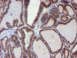 ERBB2 / HER2 Antibody - IHC of paraffin-embedded Carcinoma of Human thyroid tissue using anti-ERBB2 mouse monoclonal antibody. (Heat-induced epitope retrieval by 10mM citric buffer, pH6.0, 100C for 10min).