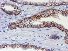 ERBB2 / HER2 Antibody - IHC of paraffin-embedded Carcinoma of Human prostate tissue using anti-ERBB2 mouse monoclonal antibody. (Heat-induced epitope retrieval by 10mM citric buffer, pH6.0, 100C for 10min).