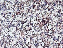 ERBB2 / HER2 Antibody - IHC of paraffin-embedded Carcinoma of Human kidney tissue using anti-ERBB2 mouse monoclonal antibody. (Heat-induced epitope retrieval by 10mM citric buffer, pH6.0, 120°C for 3min).