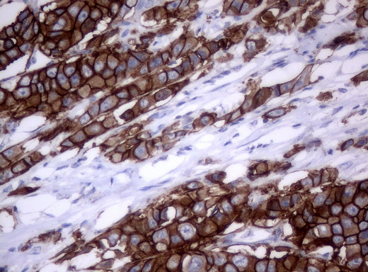 ERBB2 / HER2 Antibody - Immunohistochemical staining of paraffin-embedded Carcinoma of breast tissue. (HER2+++; heat-induced epitope retrieval by 10mM citric buffer, pH6.0, 120C for 3min) using anti-ERBB2mouse monoclonal antibody. (Clone UMAB34, dilution 1:100; heat-induced epito